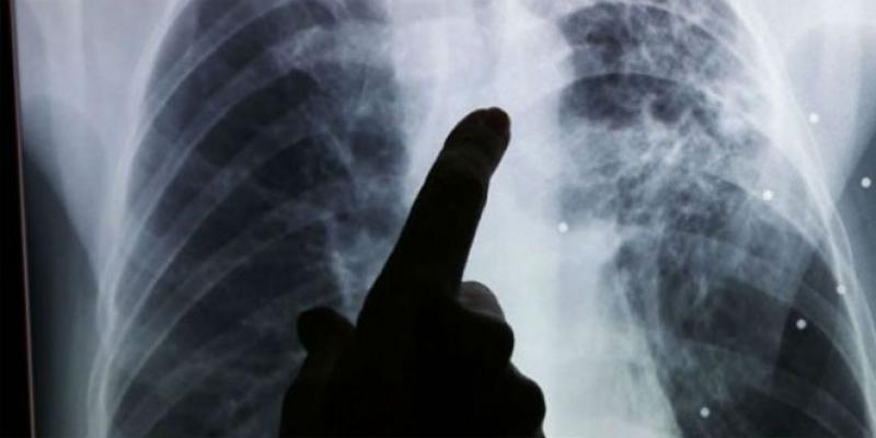 Tuberculose: Un médicament qui tue